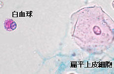 白血球と扁平上皮細胞の写真
