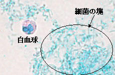 白血球と細菌の塊の写真