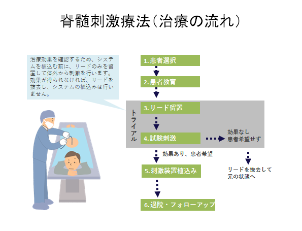 脊髄刺激療法 トライアル